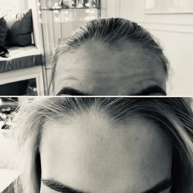 Wygładzenie zmarszczek poziomych czoła — efekt zabiegu