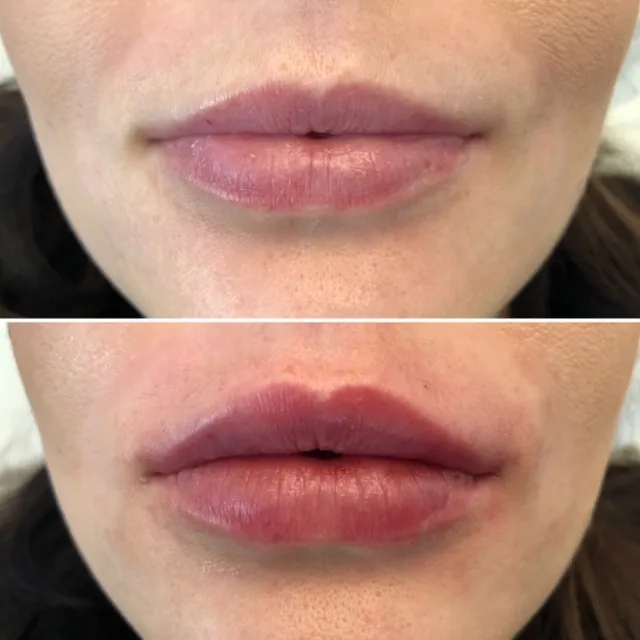 Subtelne powiększenie ust — efekt zabiegu